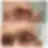 Before forehead and eyebrow reconstruction, primary view
