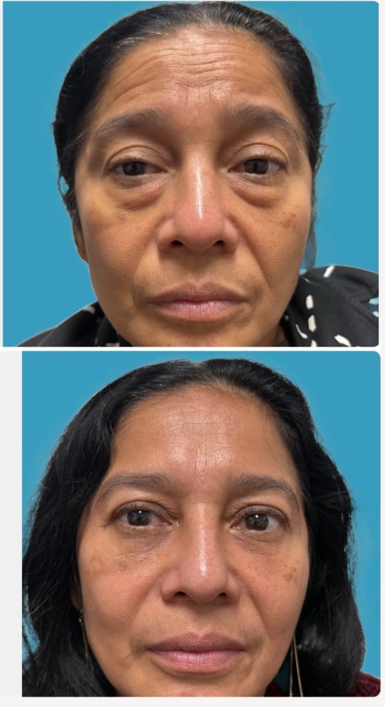 Before lower blepharoplasty showing under-eye rejuvenation, frontal view