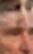 Before removal of a lesion near the inner eyelid region, oblique view
