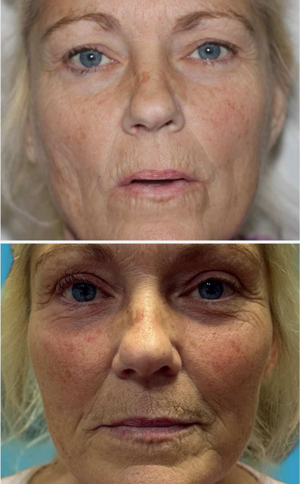 Before upper blepharoplasty, frontal view