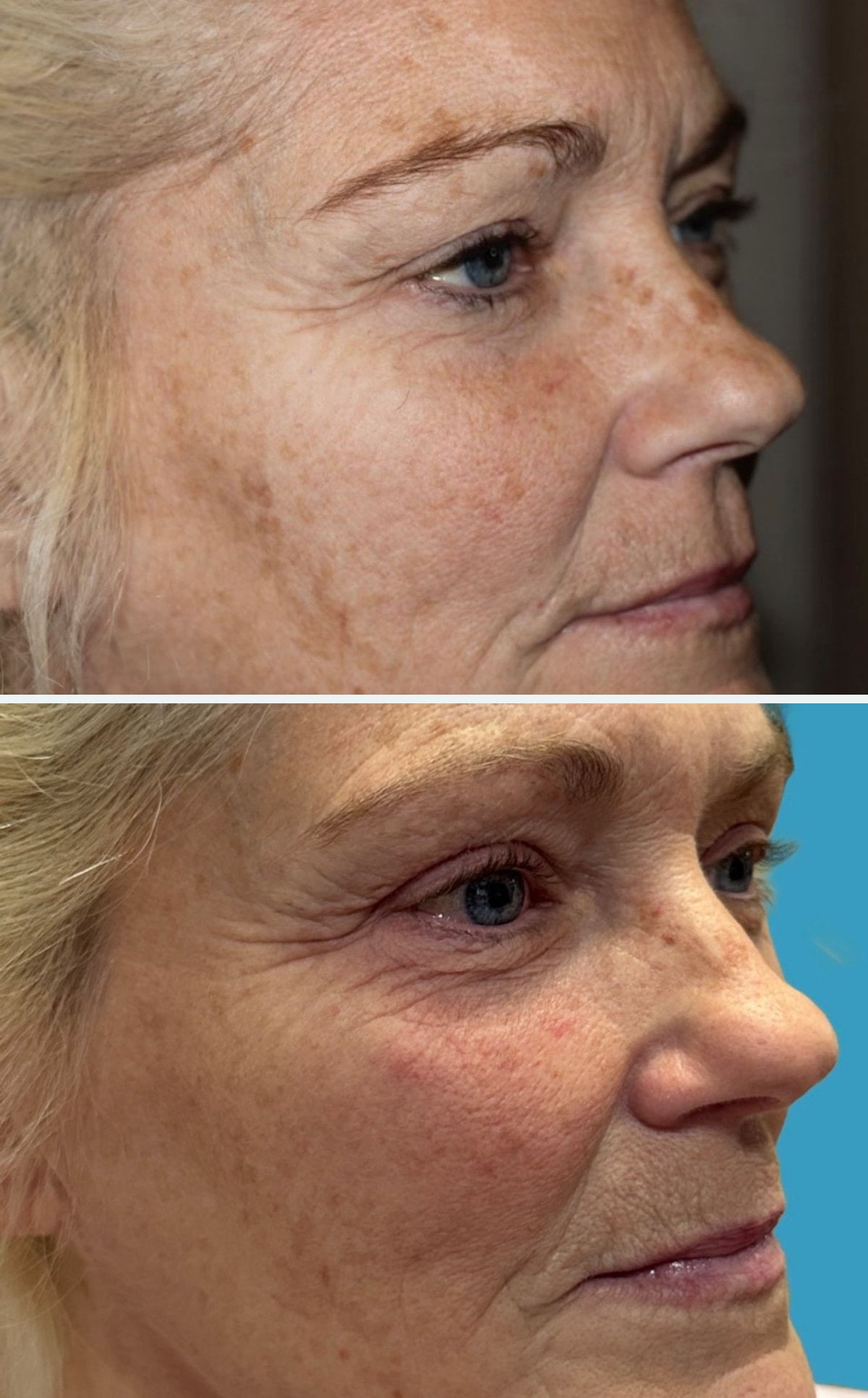 Before upper blepharoplasty, first oblique view