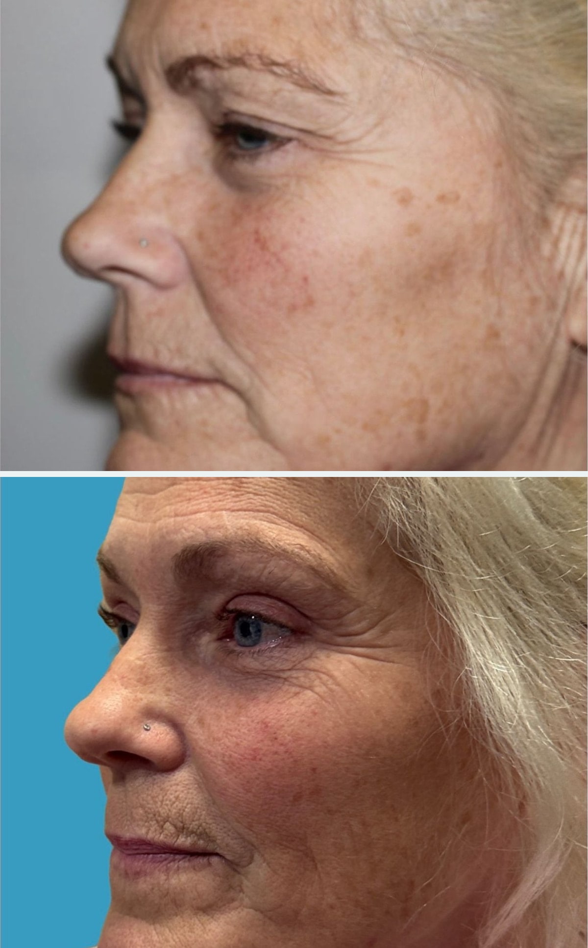 Before upper blepharoplasty, second oblique view