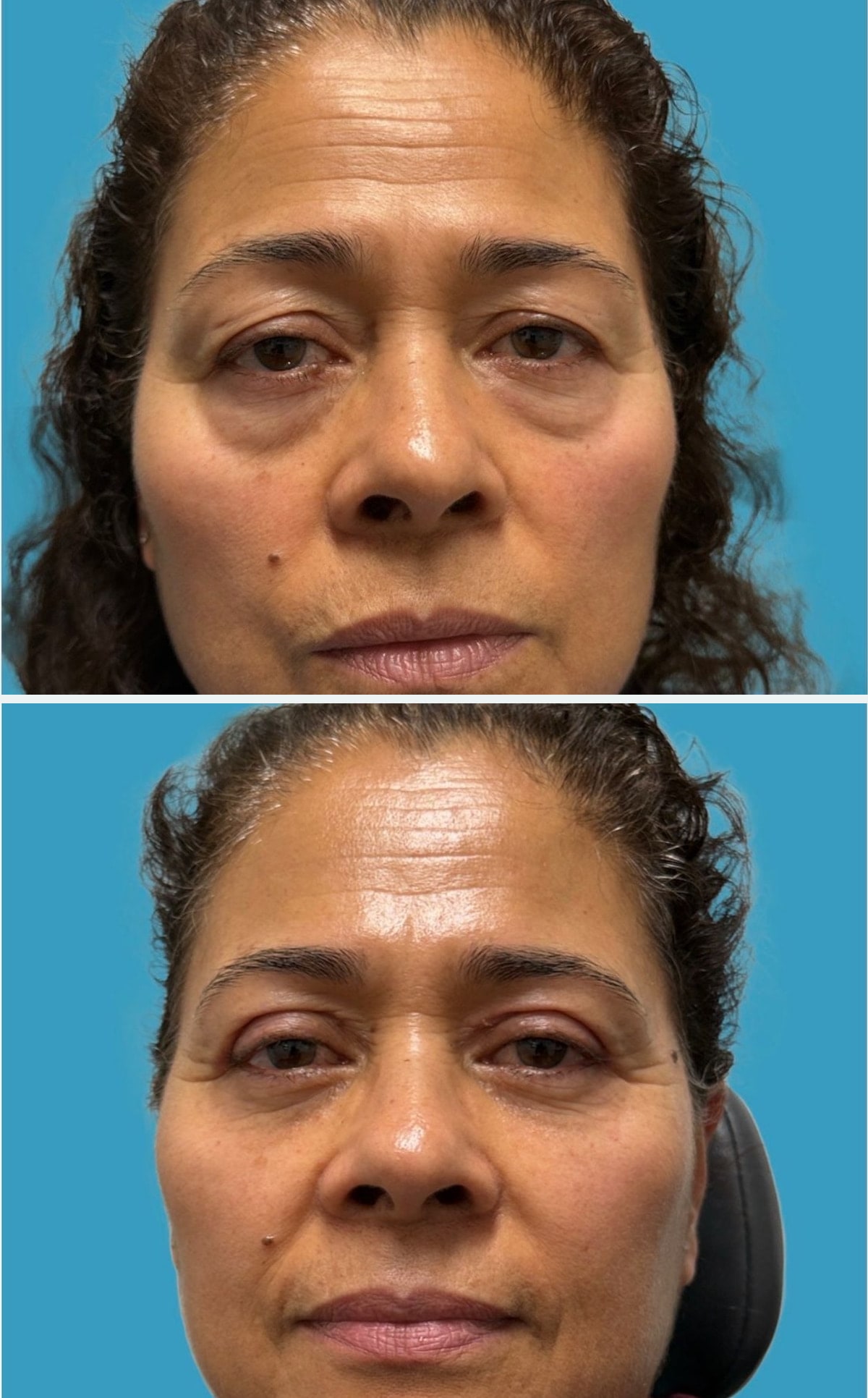 Before upper and lower blepharoplasty, frontal view