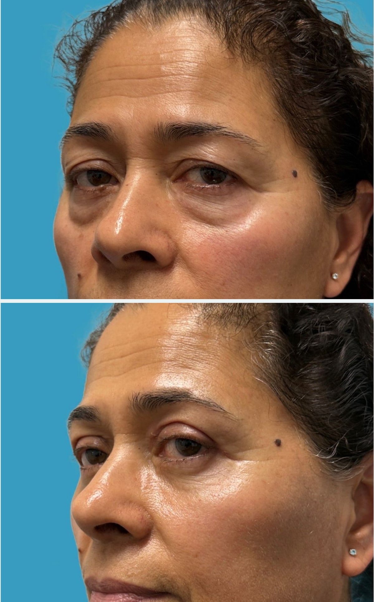 Before upper and lower blepharoplasty, first oblique view