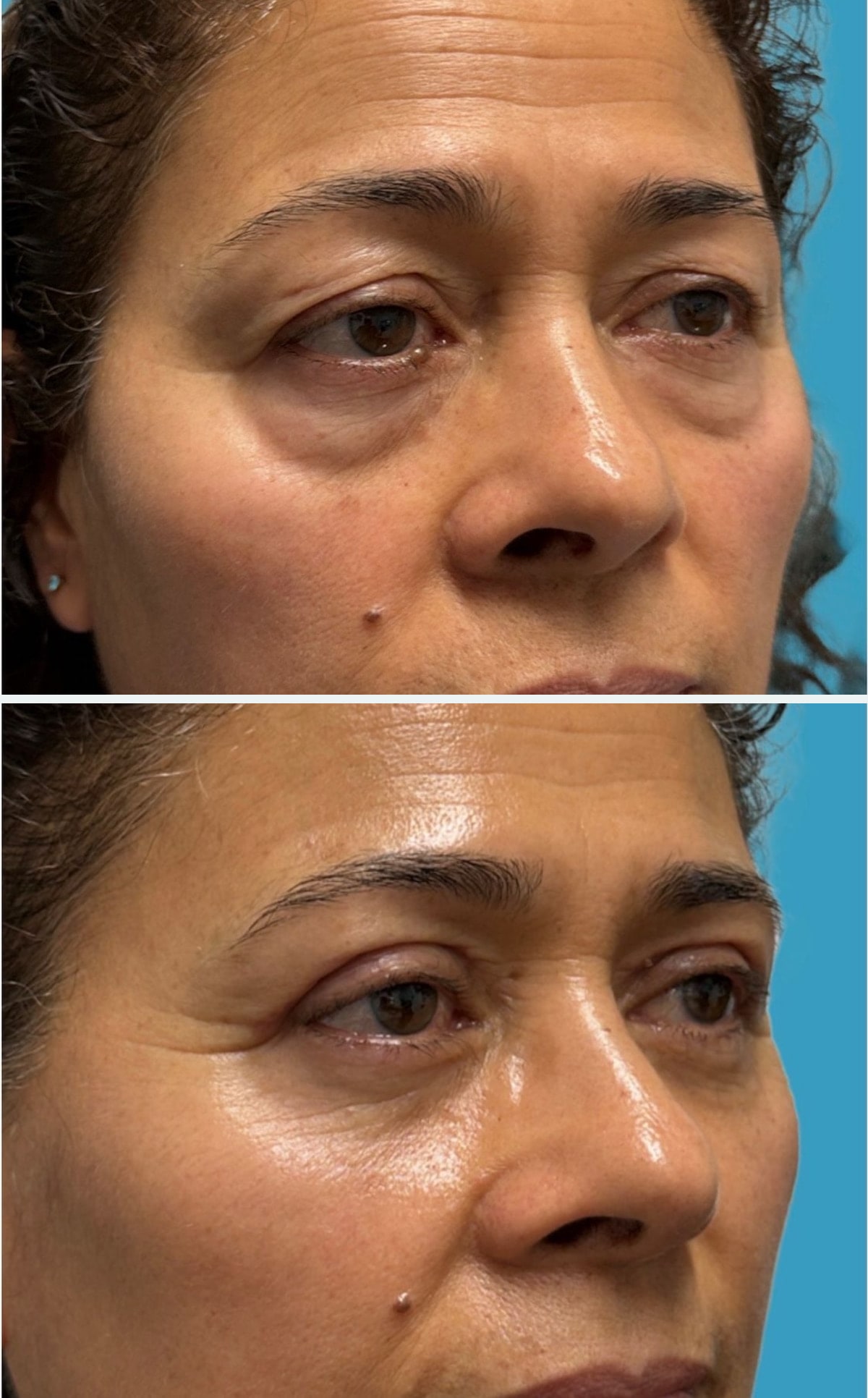 Before upper and lower blepharoplasty, second oblique view